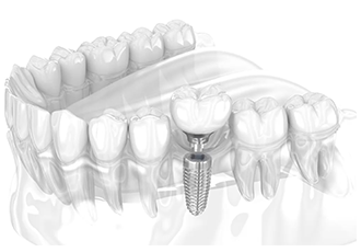 implantes_inicio